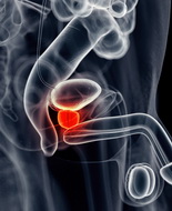 Prostatectomia radicale: i pazienti hanno aspettative irrealistiche su post-operatorio